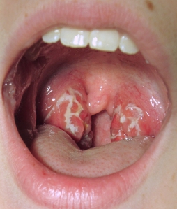 Strep throat infection